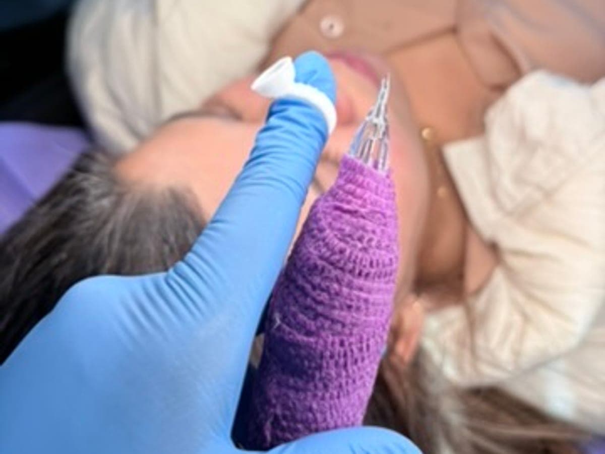 Microneedling Facial