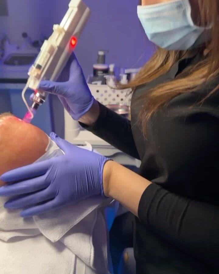 Vampire Facial (PRP)