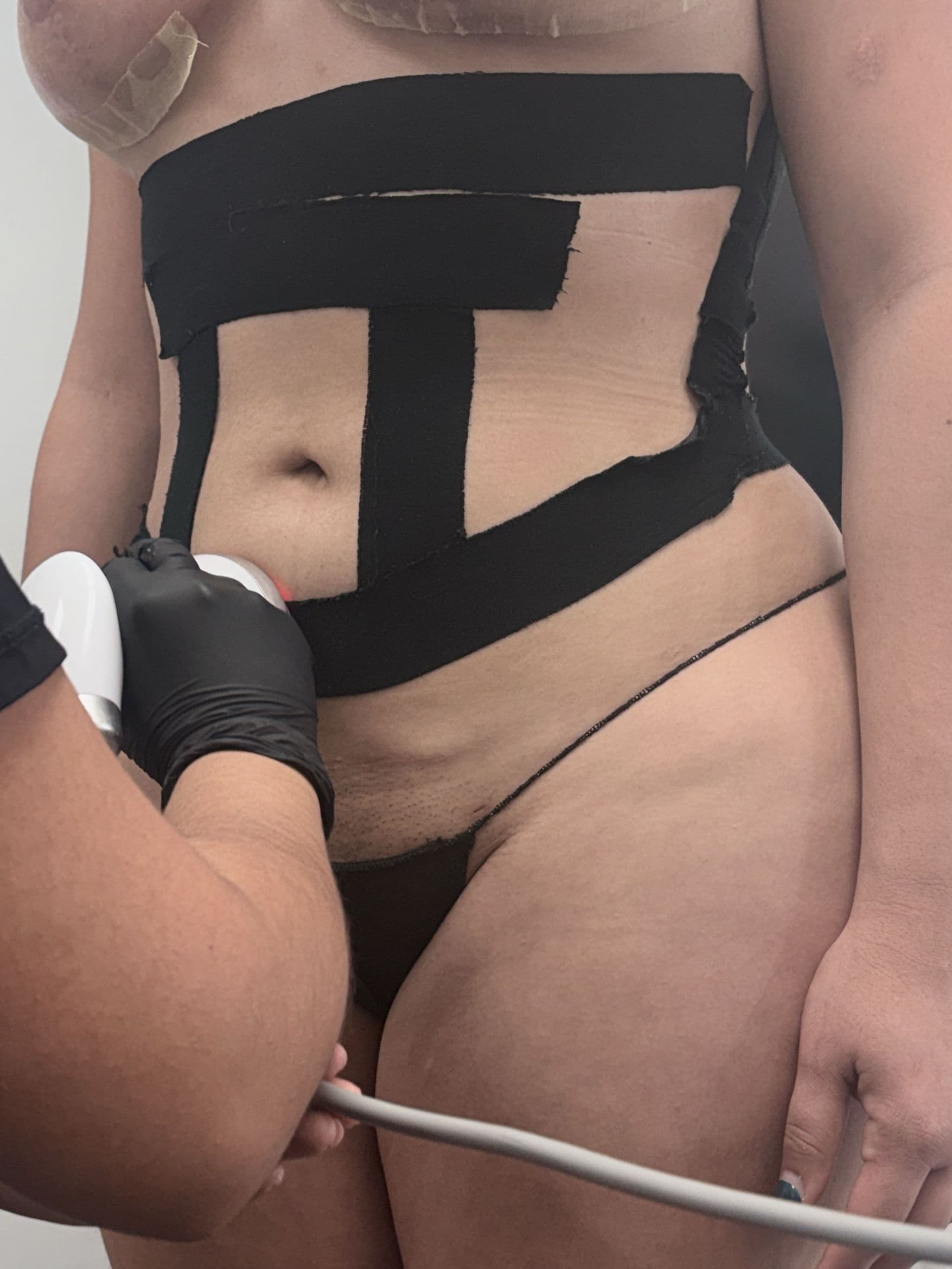 Cellulite Removal