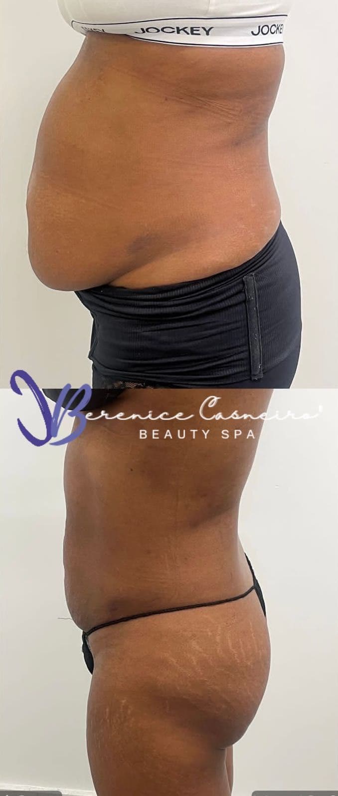 Body Contouring